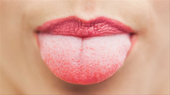 Chẩn đoán bệnh ung thư qua màu sắc lưỡi như thế nào?