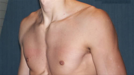Bệnh lõm lồng ngực bẩm sinh có thể phẫu thuật nâng ngực được không?
