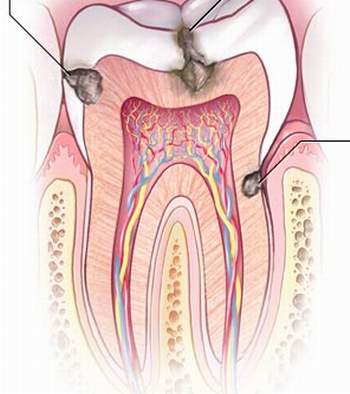 Sâu răng và các yếu tố nguy cơ cần phòng tránh và điều trị