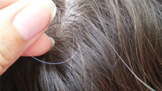 Bệnh tóc bạc sớm ở trẻ em: nguyên nhân và hướng điều trị
