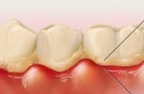 Cao răng luôn là thủ phạm chính gây nên bệnh nha chu