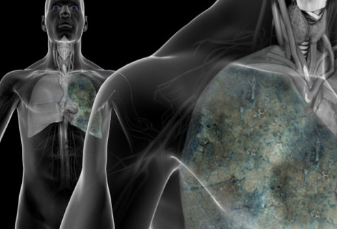 Những dấu hiệu nhận biết và cách điều trị bệnh ung thư phổi