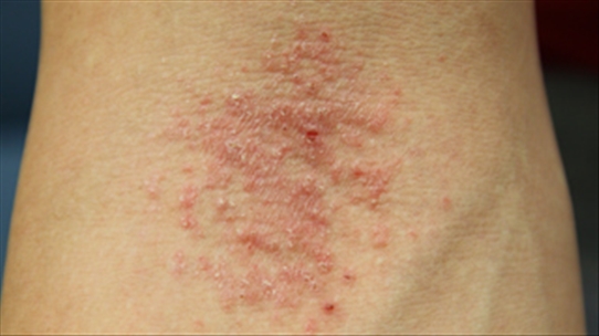 Những điều người mắc bệnh eczema cần phải tránh xa
