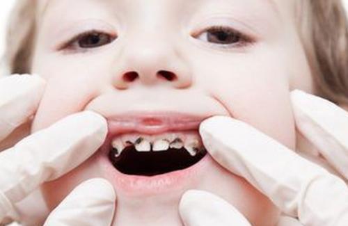Phơi nhiễm khói thuốc sớm có thể dẫn tới sâu răng ở trẻ bạn đã biết hay chưa?