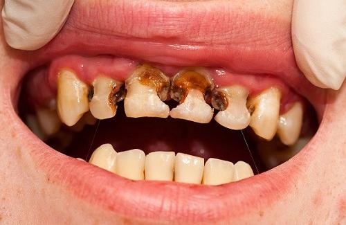 Chải răng đúng cách phòng ngừa 80% sâu răng và viêm nướu
