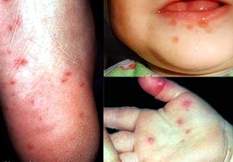Sự nguy hiểm của các virut gây bệnh tay chân miệng mà bạn chưa biết
