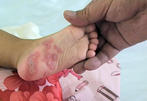 Cảnh báo: Trẻ có thể mắc bệnh tay chân miệng nhiều lần