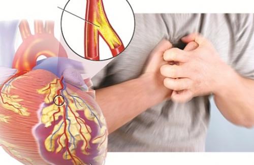 Bệnh tim mạch vành là gì? Những nguyên nhân gây bệnh tim mạch vành