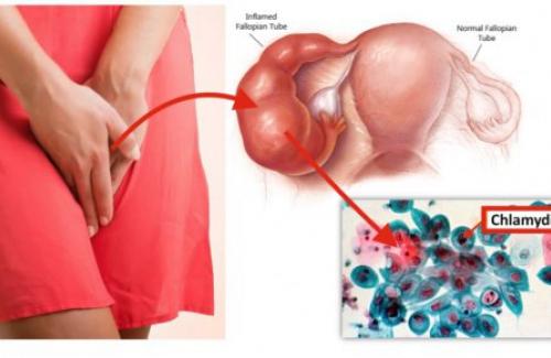Chlamydia trachomatis - Kẻ thù của sức khỏe sinh sản bạn có biết?