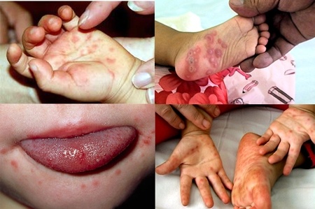 Cha mẹ nên làm gì để ngăn chặn bệnh tay chân miệng cho trẻ ?
