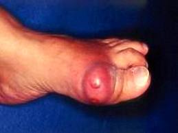 Khớp ngón chân cái sưng đỏ, cảnh báo bệnh gút đang "tấn công" bạn