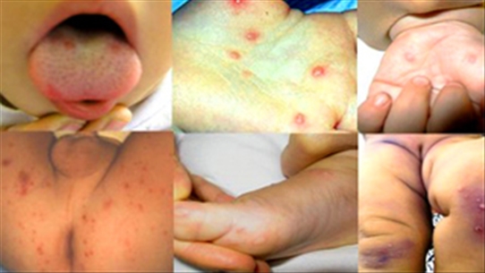 Hướng dẫn phân biệt bệnh tay chân miệng với sốt vi-rút nổi ban
