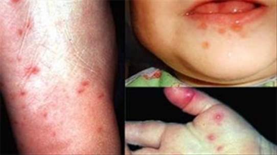 Nhận dạng các "thủ phạm" gây bệnh tay chân miệng ở trẻ