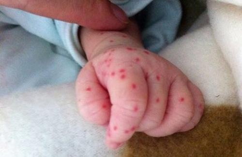 Triệu chứng sốt xuất huyết ở trẻ sơ sinh, biết sớm để chữa trị cho bé yêu