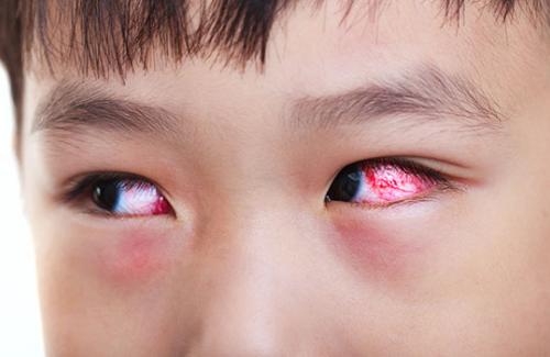Tổng quan về đau mắt đỏ - Bệnh phổ biến khi chuyển mùa