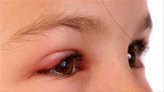 Những triệu chứng điển hình giúp bạn "nhận dạng" bệnh đau mắt đỏ