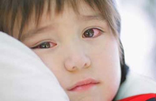 Đau mắt đỏ ở trẻ - Những điều cha mẹ cần phải lưu ý
