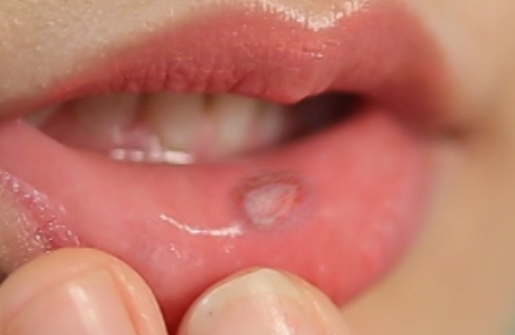 Giới thiệu 10 bài thuốc dân gian trị viêm loét miệng hiệu quả