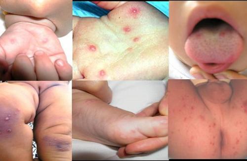 triệu chứng bệnh tay chân miệng ở trẻ em, ba mẹ chớ quên tìm hiểu!