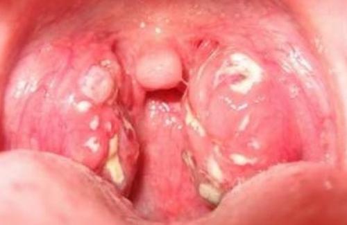 Tìm hiểu hội chứng vết loét - hạch - ban trong bệnh sốt mò