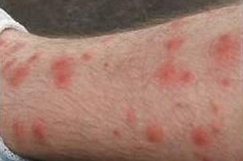 Hội chứng vết loét - hạch - ban trong căn bệnh sốt mò
