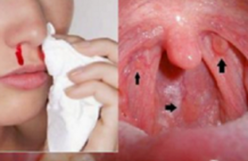 Những dấu hiệu của bệnh ung thư vòm họng mà bạn chưa biết
