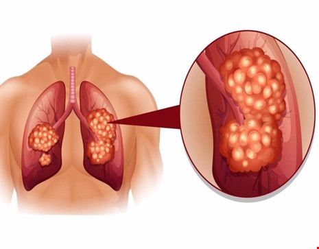 Những dấu hiệu không ngờ của căn bệnh ung thư phổi
