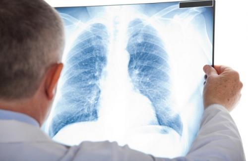 Ung thư phổi di căn có tỷ lệ tử vong cao do phát hiện muộn