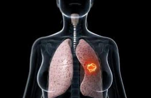 Ung thư phổi giai đoạn 1 - Khởi phát mức độ nguy hiểm của bệnh
