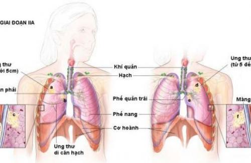 Ung thư phổi giai đoạn cuối liệu có chữa được không?