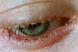 Viêm nhiễm bờ mi mắt: Các triệu chứng và cách điều trị