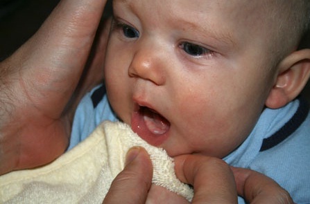 Bệnh răng miệng ở trẻ dưới 6 tháng tuổi biểu hiện thế nào?