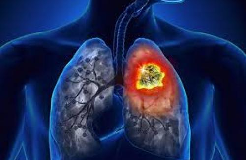 Dấu hiệu ung thư phổi giai đoạn đầu phát hiện sớm làm tăng khả năng điều trị