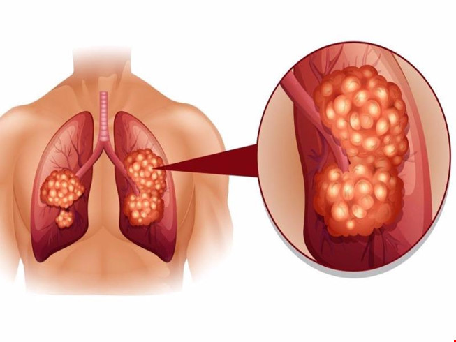 Một số dấu hiệu không ngờ của căn bệnh ung thư phổi mà bạn ít biết