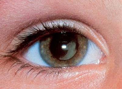 Hở mi mắt: Hiểm họa khôn lường nếu không điều trị kịp thời