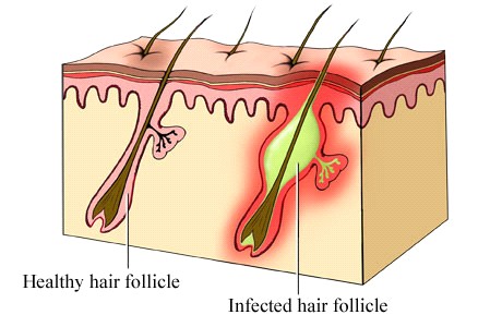 Thuốc trị bệnh viêm nang lông hiệu quả mà bạn chưa biết