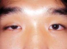 Sa mi mắt ở trẻ có biểu hiện gì và cách điều trị hiệu quả