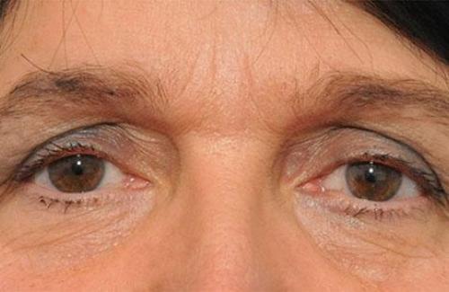 Sụp mi mắt ở người cao tuổi: Biểu hiện và cách điều trị