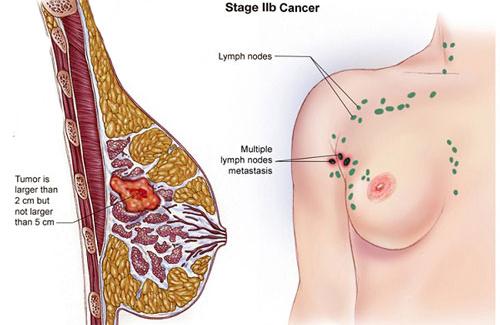 Triệu chứng bệnh ung thư vú, những điều chị em nên biết