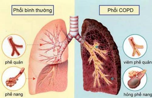 Tắc nghẽn phổi vì hút thuốc lá: Người bệnh khốn khổ chẳng kém bệnh ung thư