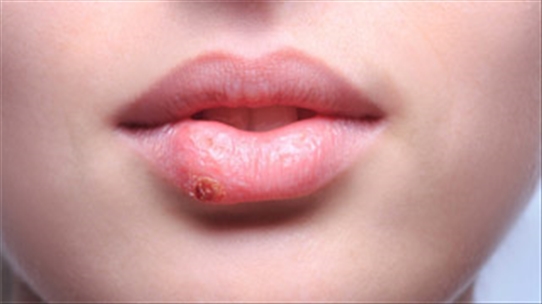 Dùng thuốc gì để điều trị nhanh khỏi khi bị herpes miệng?