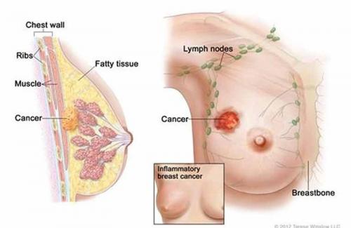 Mách bạn cách phòng và điều trị bệnh ung thư vú ở phụ nữ