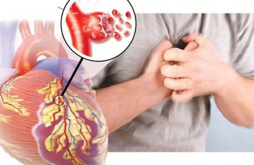 Đột quỵ tim - Bệnh tim mạch phổ biến vô cùng nguy hiểm