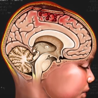U mạch não thần kinh sinh ba, biểu hiện đặc trưng là gì?