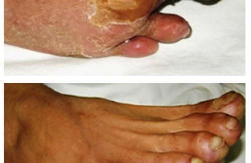 Chăm sóc bàn chân ở người bệnh mắc chứng đái tháo đường
