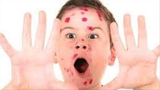 Các phương pháp giúp đoán bệnh khi trẻ bị sốt, nổi ban đỏ