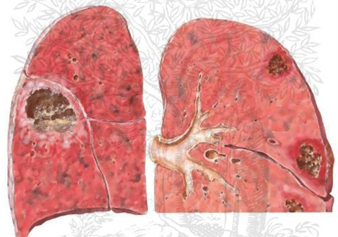 Người bệnh cần đặc biệt cảnh giác với bệnh phổi kẽ