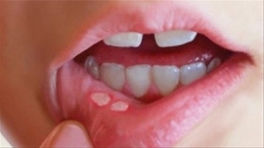 Những biện pháp giảm thiểu tác động của những vết loét miệng