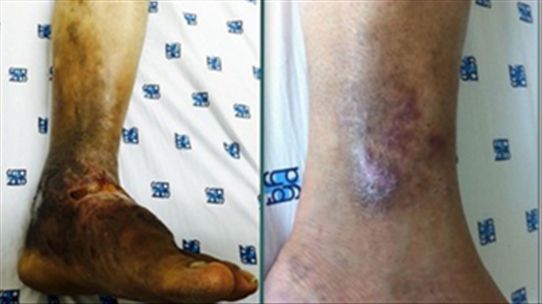 Căn bệnh nguy hiểm khiến bạn có thể phải cắt chân nguy hiểm như thế nào?
