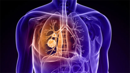 Ung thư biểu mô tế bào lớn của phổi - Căn bệnh nguy hiểm